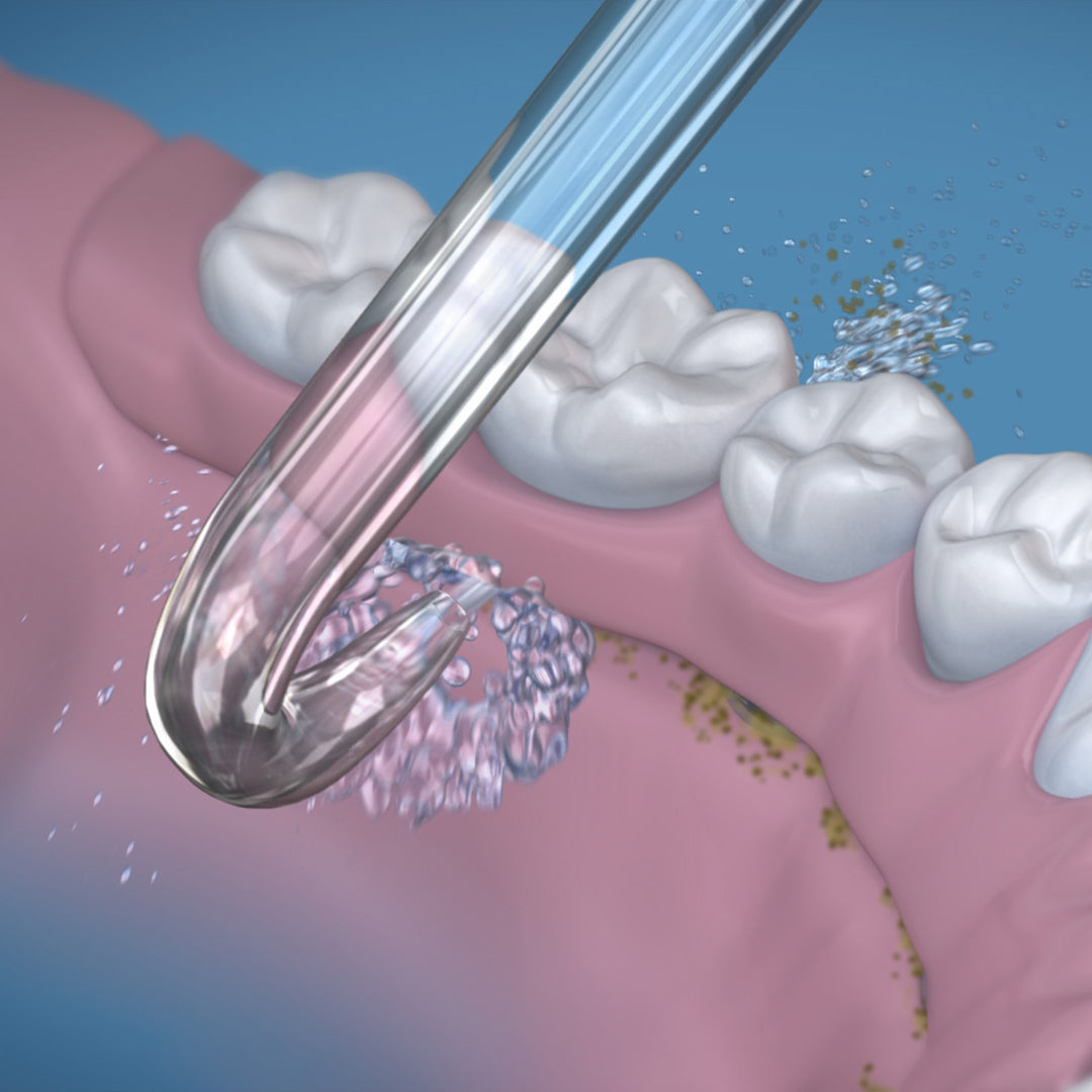 Using the Waterpik implant tip on the lower arch